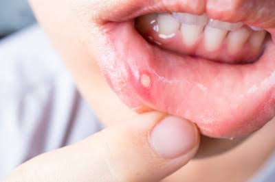 Following are the most common oral infections, sufferers can be made toothless