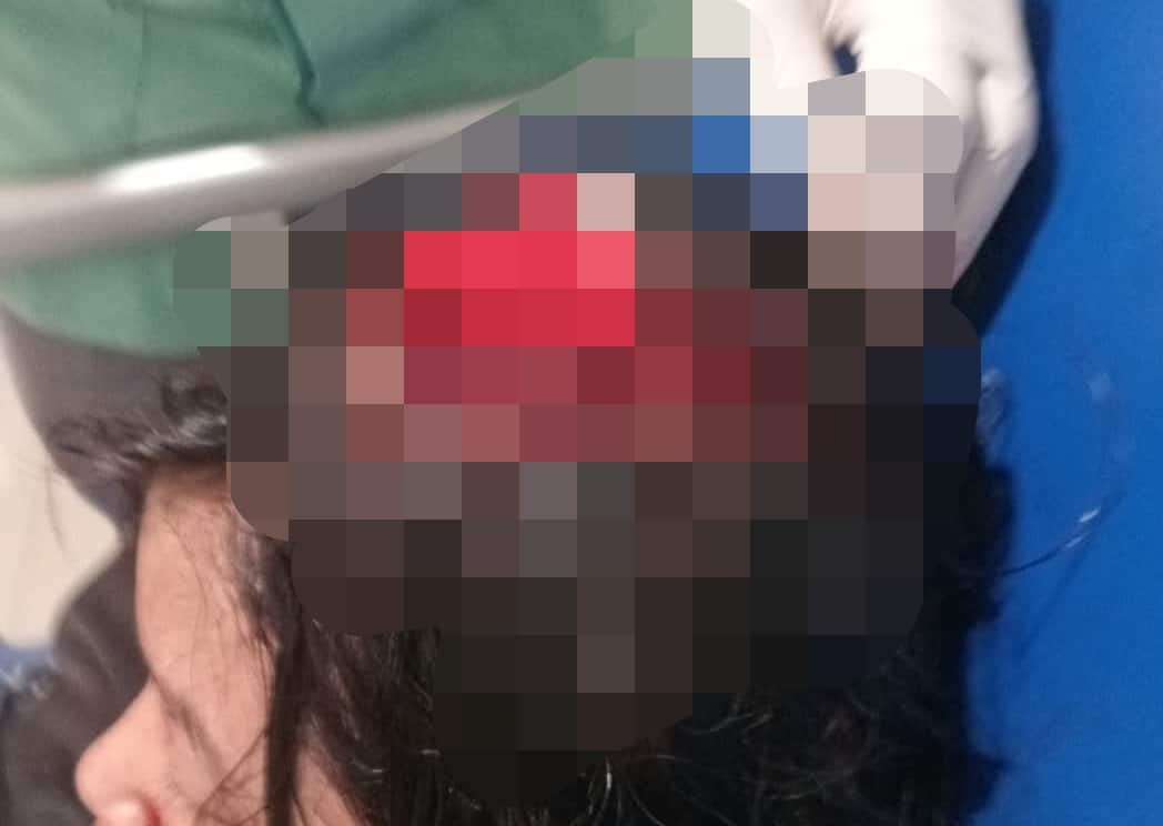 Kepala Bocor, Anak Korban Jambret di Dumai Tak Bisa Klaim BPJS